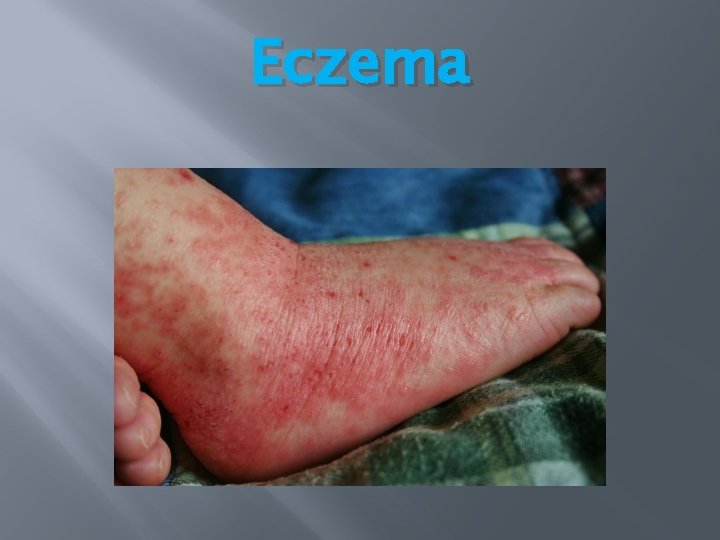 Eczema Eczema