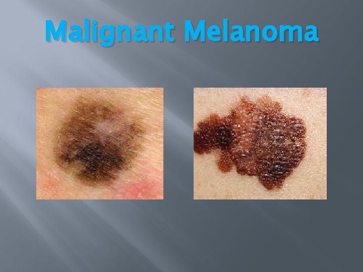 Malignant Melanoma Malignant Melanoma