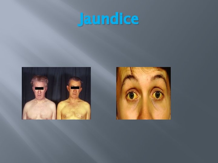 Jaundice Jaundice