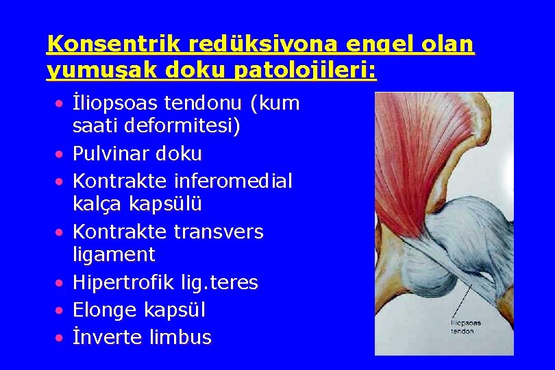 Konsentrik redüksiyona engel olan yumuşak doku patolojileri: • İliopsoas tendonu (kum saati deformitesi) •