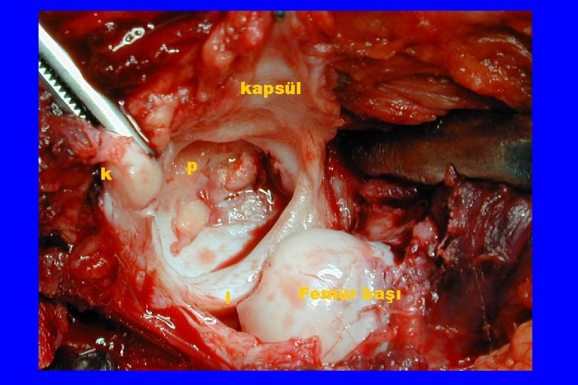 kapsül k p l Femur başı 