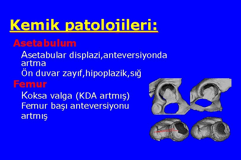 Kemik patolojileri: Asetabulum Asetabular displazi, anteversiyonda artma Ön duvar zayıf, hipoplazik, sığ Femur Koksa