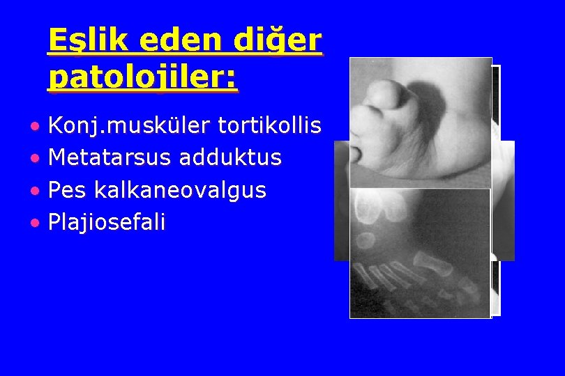 Eşlik eden diğer patolojiler: • Konj. musküler tortikollis • Metatarsus adduktus • Pes kalkaneovalgus