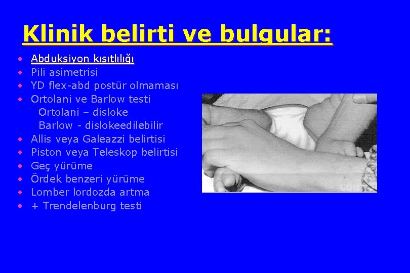 Klinik belirti ve bulgular: • • • Abduksiyon kısıtlılığı Pili asimetrisi YD flex-abd postür