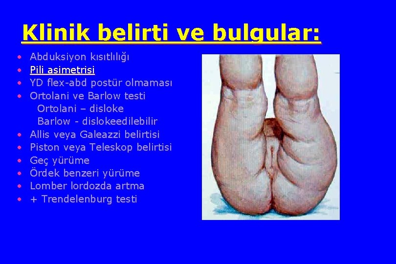 Klinik belirti ve bulgular: • • • Abduksiyon kısıtlılığı Pili asimetrisi YD flex-abd postür