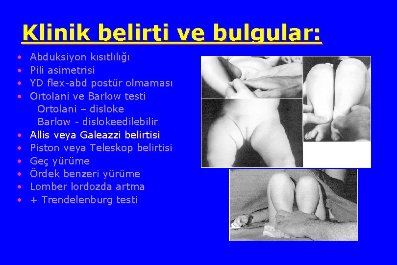 Klinik belirti ve bulgular: • • • Abduksiyon kısıtlılığı Pili asimetrisi YD flex-abd postür