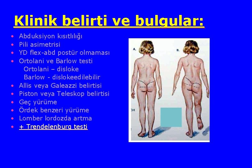 Klinik belirti ve bulgular: • • • Abduksiyon kısıtlılığı Pili asimetrisi YD flex-abd postür