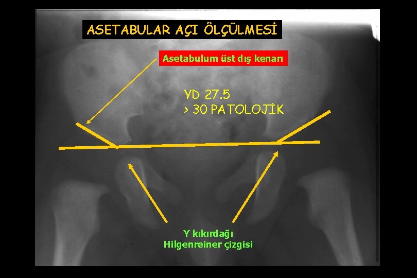 ASETABULAR AÇI ÖLÇÜLMESİ Asetabulum üst dış kenarı YD 27. 5 > 30 PATOLOJİK Y