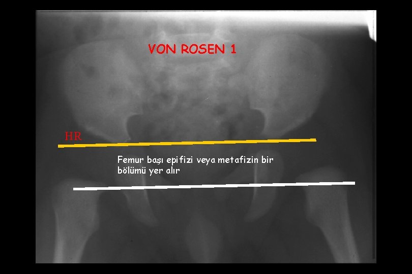 VON ROSEN 1 HR Femur başı epifizi veya metafizin bir bölümü yer alır 