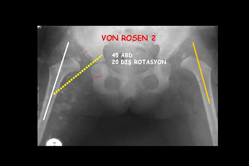 VON ROSEN 2 45 ABD 20 DIŞ ROTASYON 