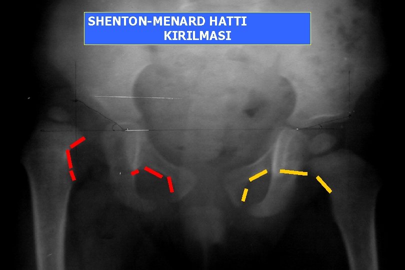 SHENTON-MENARD HATTI KIRILMASI 