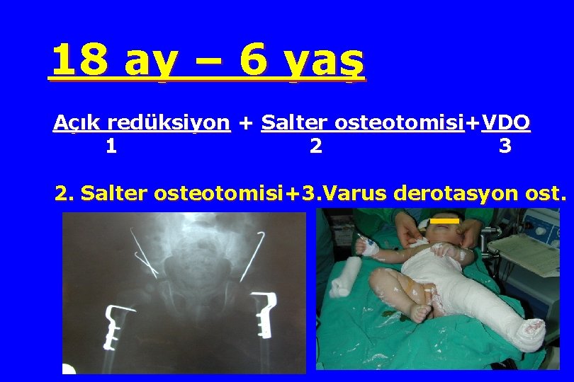 18 ay – 6 yaş Açık redüksiyon + Salter osteotomisi+VDO 1 2 3 2.