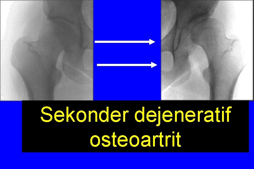 Sekonder dejeneratif osteoartrit TEMAS ALANI = 26. 7 cm Birim alana düşen yük miktarı