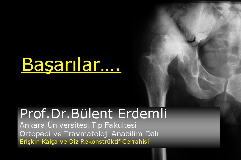 Başarılar…. Prof. Dr. Bülent Erdemli Ankara Üniversitesi Tıp Fakültesi Ortopedi ve Travmatoloji Anabilim Dalı