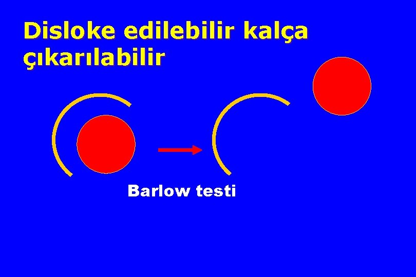 Disloke edilebilir kalça çıkarılabilir Barlow testi 