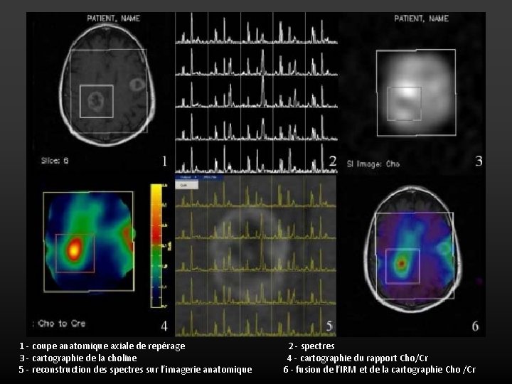 1 - coupe anatomique axiale de repérage 3 - cartographie de la choline 5