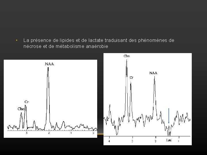  • La présence de lipides et de lactate traduisant des phénomènes de nécrose