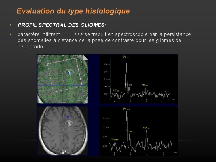 Evaluation du type histologique • PROFIL SPECTRAL DES GLIOMES: • caractère infiltrant ++++>>> se