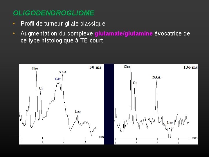 OLIGODENDROGLIOME • Profil de tumeur gliale classique • Augmentation du complexe glutamate/glutamine évocatrice de