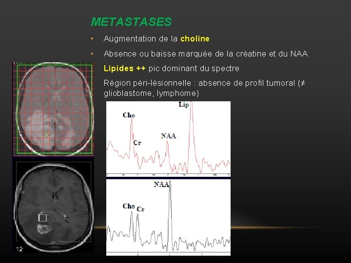 METASTASES • Augmentation de la choline • Absence ou baisse marquée de la créatine