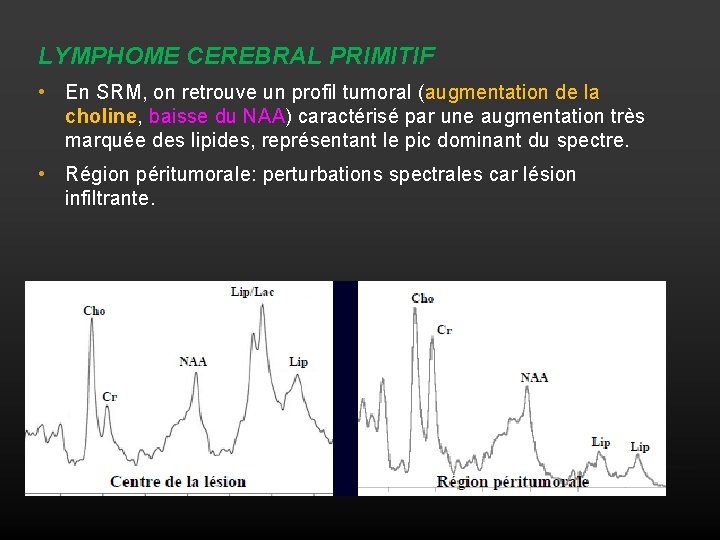 LYMPHOME CEREBRAL PRIMITIF • En SRM, on retrouve un profil tumoral (augmentation de la