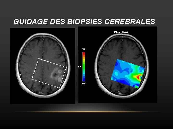GUIDAGE DES BIOPSIES CEREBRALES 