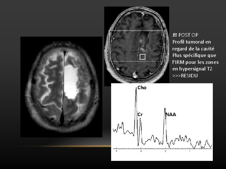 J 8 POST OP Profil tumoral en regard de la cavité Plus spécifique l’IRM