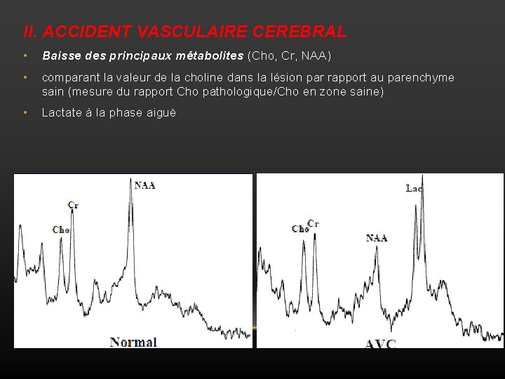 II. ACCIDENT VASCULAIRE CEREBRAL • Baisse des principaux métabolites (Cho, Cr, NAA) • comparant