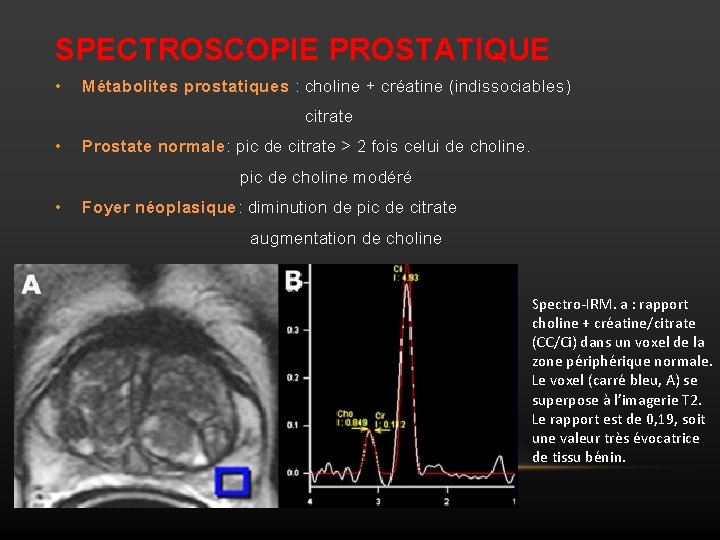 SPECTROSCOPIE PROSTATIQUE • Métabolites prostatiques : choline + créatine (indissociables) citrate • Prostate normale: