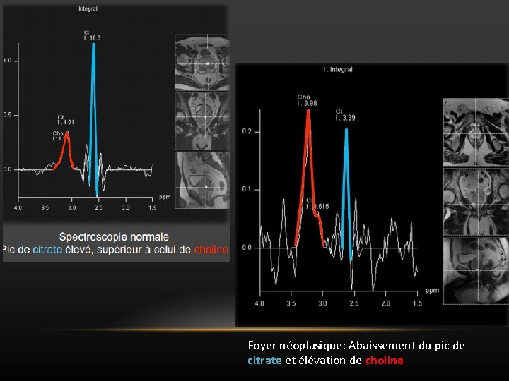 Foyer néoplasique: Abaissement du pic de citrate et élévation de choline 