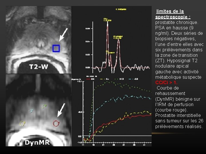 limites de la spectroscopie : prostatite chronique. PSA en hausse (9 ng/ml). Deux séries