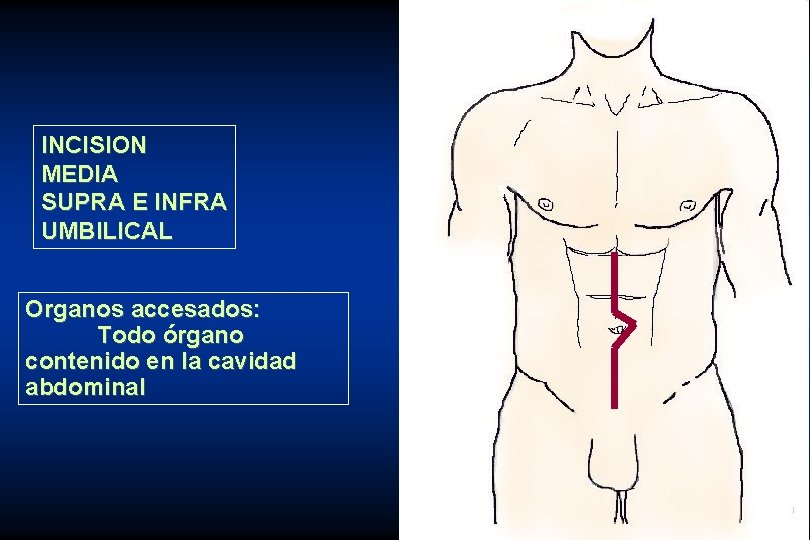 INCISION MEDIA SUPRA E INFRA UMBILICAL Organos accesados: Todo órgano contenido en la cavidad