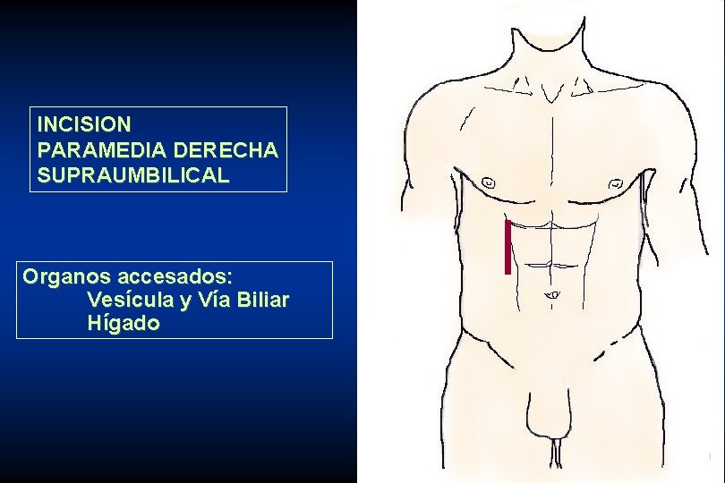 INCISION PARAMEDIA DERECHA SUPRAUMBILICAL Organos accesados: Vesícula y Vía Biliar Hígado 