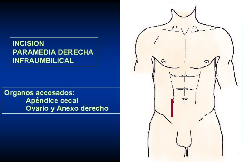 INCISION PARAMEDIA DERECHA INFRAUMBILICAL Organos accesados: Apéndice cecal Ovario y Anexo derecho 