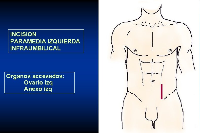 INCISION PARAMEDIA IZQUIERDA INFRAUMBILICAL Organos accesados: Ovario izq Anexo izq 