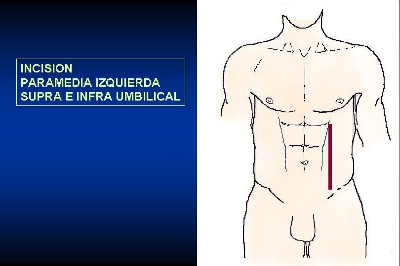 INCISION PARAMEDIA IZQUIERDA SUPRA E INFRA UMBILICAL 