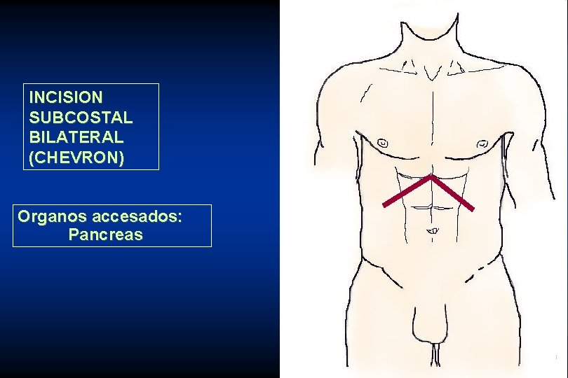 INCISION SUBCOSTAL BILATERAL (CHEVRON) Organos accesados: Pancreas 