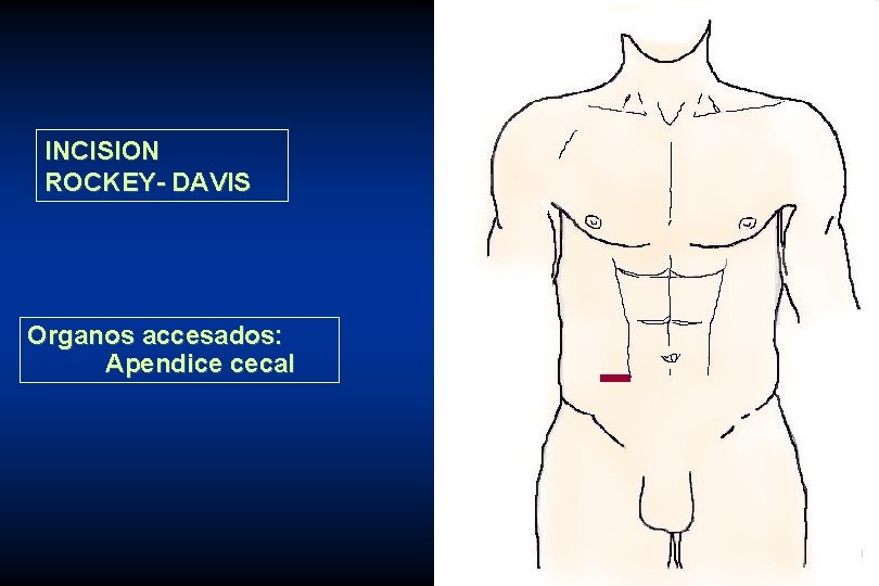 INCISION ROCKEY- DAVIS Organos accesados: Apendice cecal 