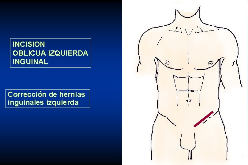 INCISION OBLICUA IZQUIERDA INGUINAL Corrección de hernias inguinales izquierda 