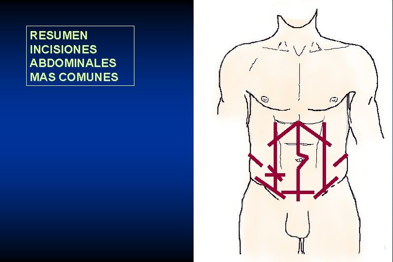 RESUMEN INCISIONES ABDOMINALES MAS COMUNES 