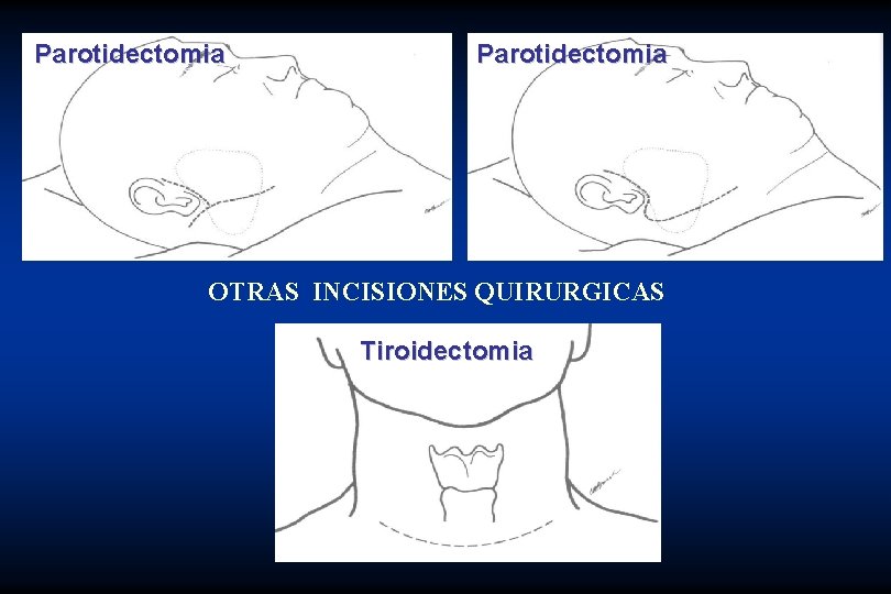 Parotidectomia OTRAS INCISIONES QUIRURGICAS Tiroidectomia 