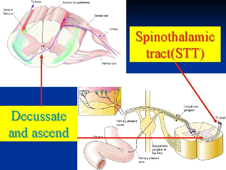 Spinothalamic tract(STT) Decussate and ascend 