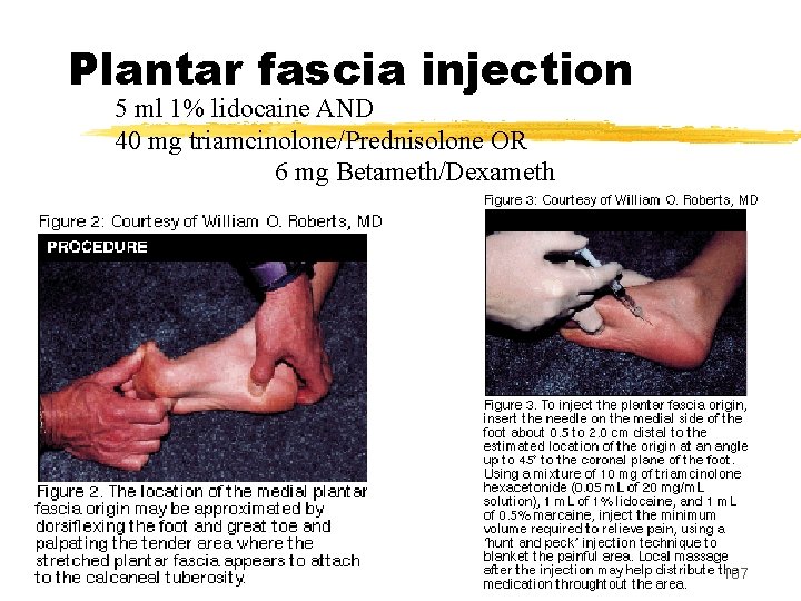 Plantar fascia injection 5 ml 1% lidocaine AND 40 mg triamcinolone/Prednisolone OR 6 mg
