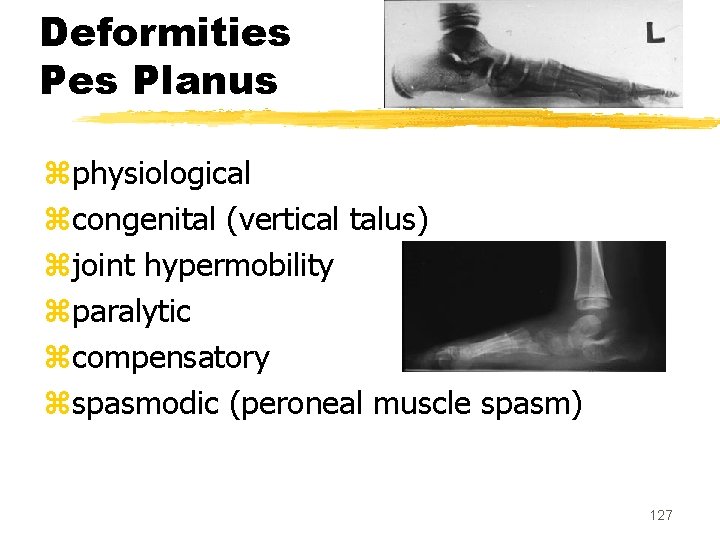 Deformities Planus zphysiological zcongenital (vertical talus) zjoint hypermobility zparalytic zcompensatory zspasmodic (peroneal muscle spasm)