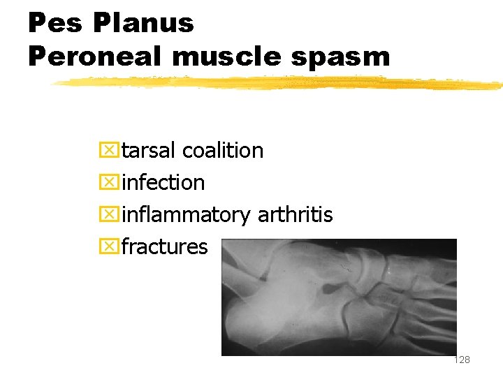 Pes Planus Peroneal muscle spasm xtarsal coalition xinfection xinflammatory arthritis xfractures 128 