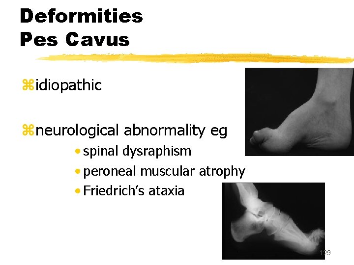 Deformities Pes Cavus zidiopathic zneurological abnormality eg • spinal dysraphism • peroneal muscular atrophy