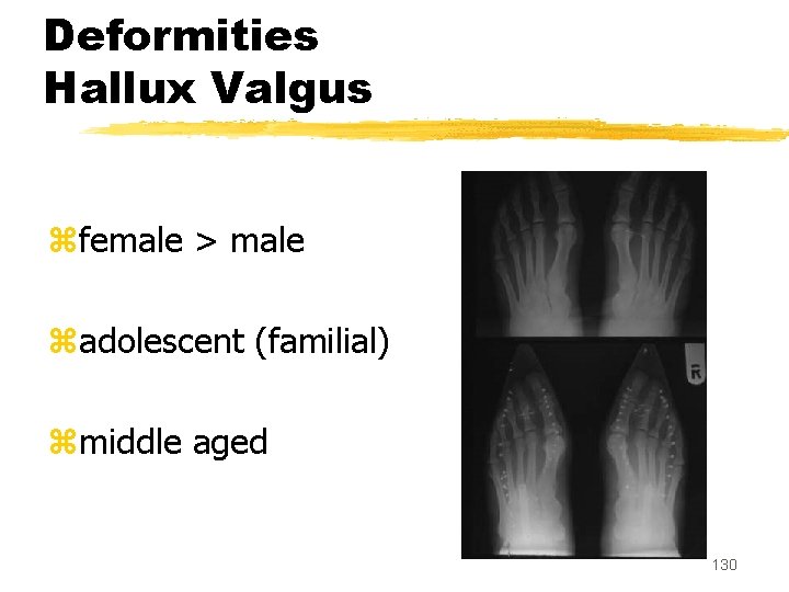 Deformities Hallux Valgus zfemale > male zadolescent (familial) zmiddle aged 130 