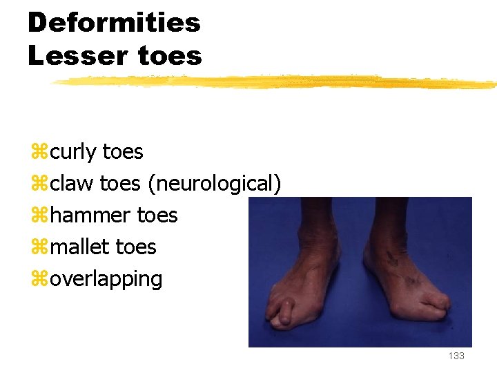 Deformities Lesser toes zcurly toes zclaw toes (neurological) zhammer toes zmallet toes zoverlapping 133