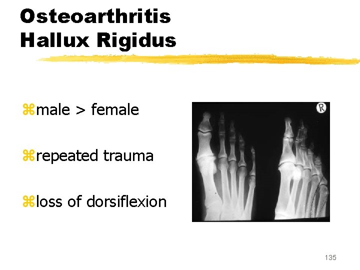 Osteoarthritis Hallux Rigidus zmale > female zrepeated trauma zloss of dorsiflexion 135 