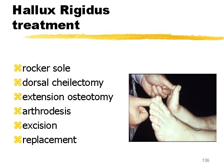 Hallux Rigidus treatment zrocker sole zdorsal cheilectomy zextension osteotomy zarthrodesis zexcision zreplacement 136 